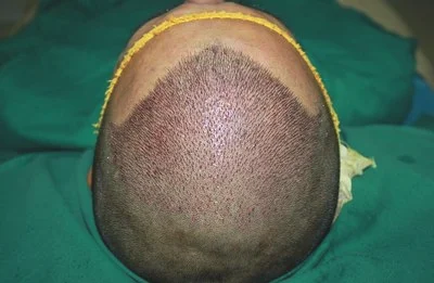 植发的危害有哪些植发对于身体的影响大吗
