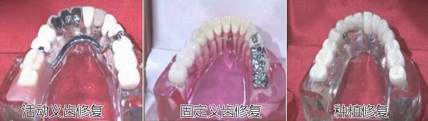 牙齿修复方法-材料