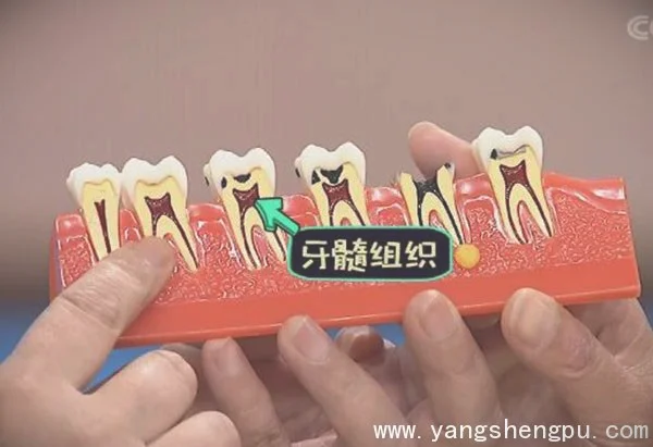 牙髓炎的原因,龋齿的形成,牙菌斑20191209健康之路